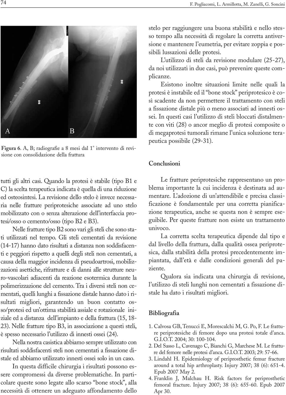 La revisione dello stelo è invece necessaria nelle fratture periprotesiche associate ad uno stelo mobilizzato con o senza alterazione dell interfaccia protesi/osso o cemento/osso (tipo B2 e B3).