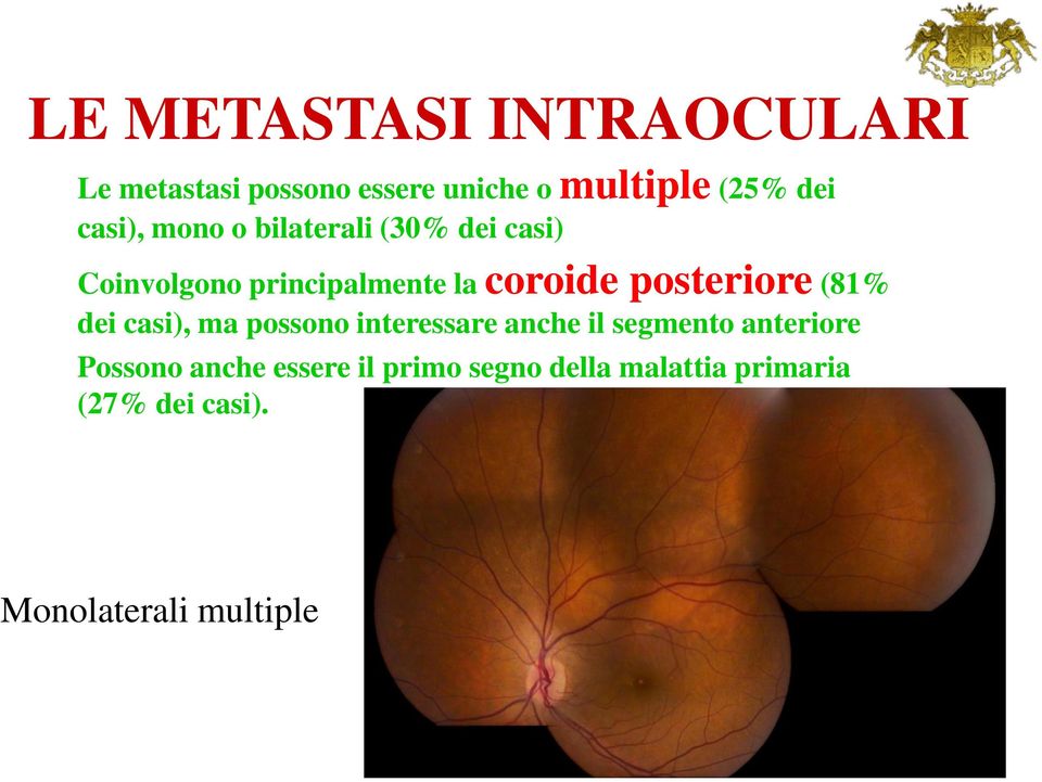 posteriore (81% dei casi), ma possono interessare anche il segmento anteriore