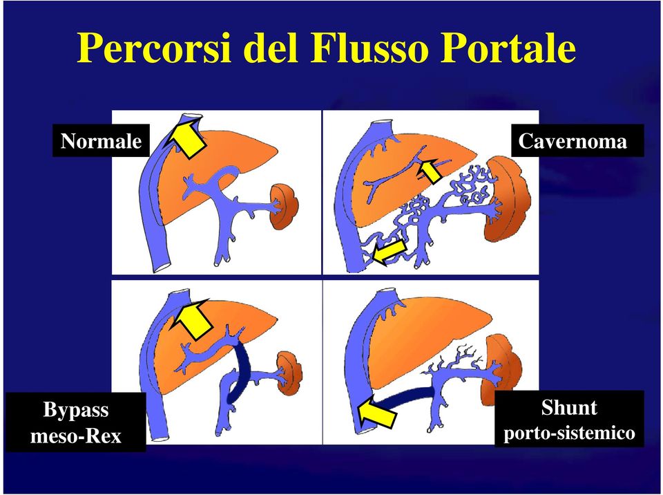 Cavernoma Bypass