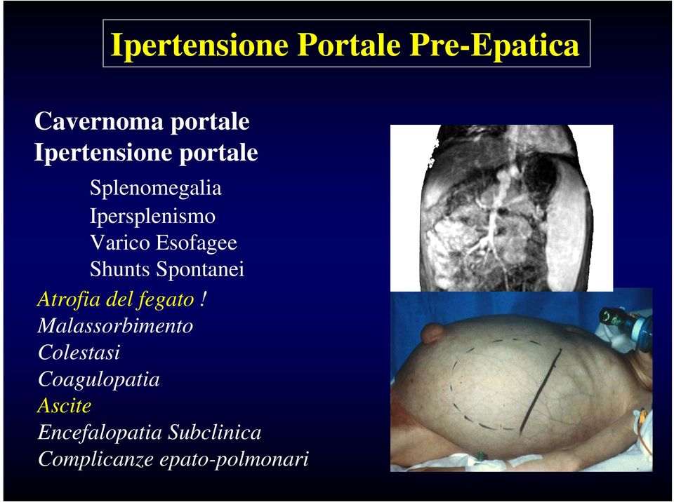 Esofagee Shunts Spontanei Atrofia del fegato!