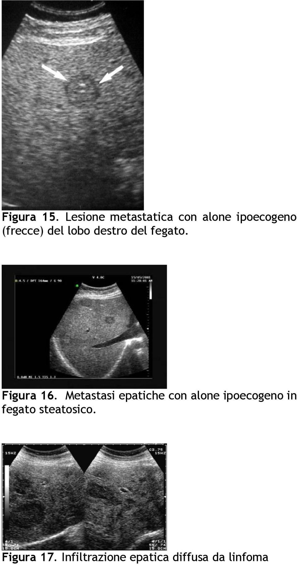 lobo destro del fegato. Figura 16.