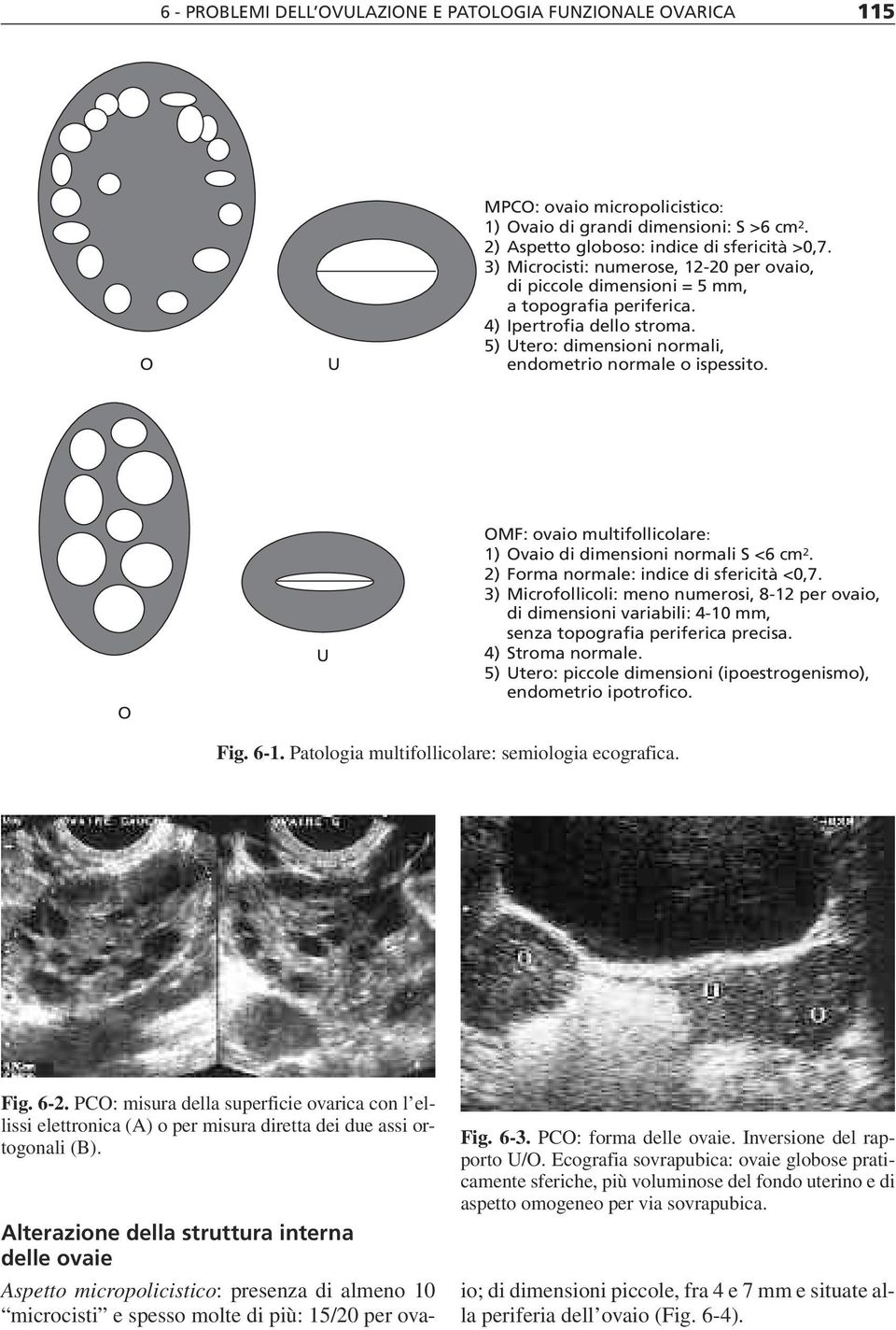 O U OMF: ovaio multifollicolare: 1) Ovaio di dimensioni normali S <6 cm 2. 2) Forma normale: indice di sfericità <0,7.