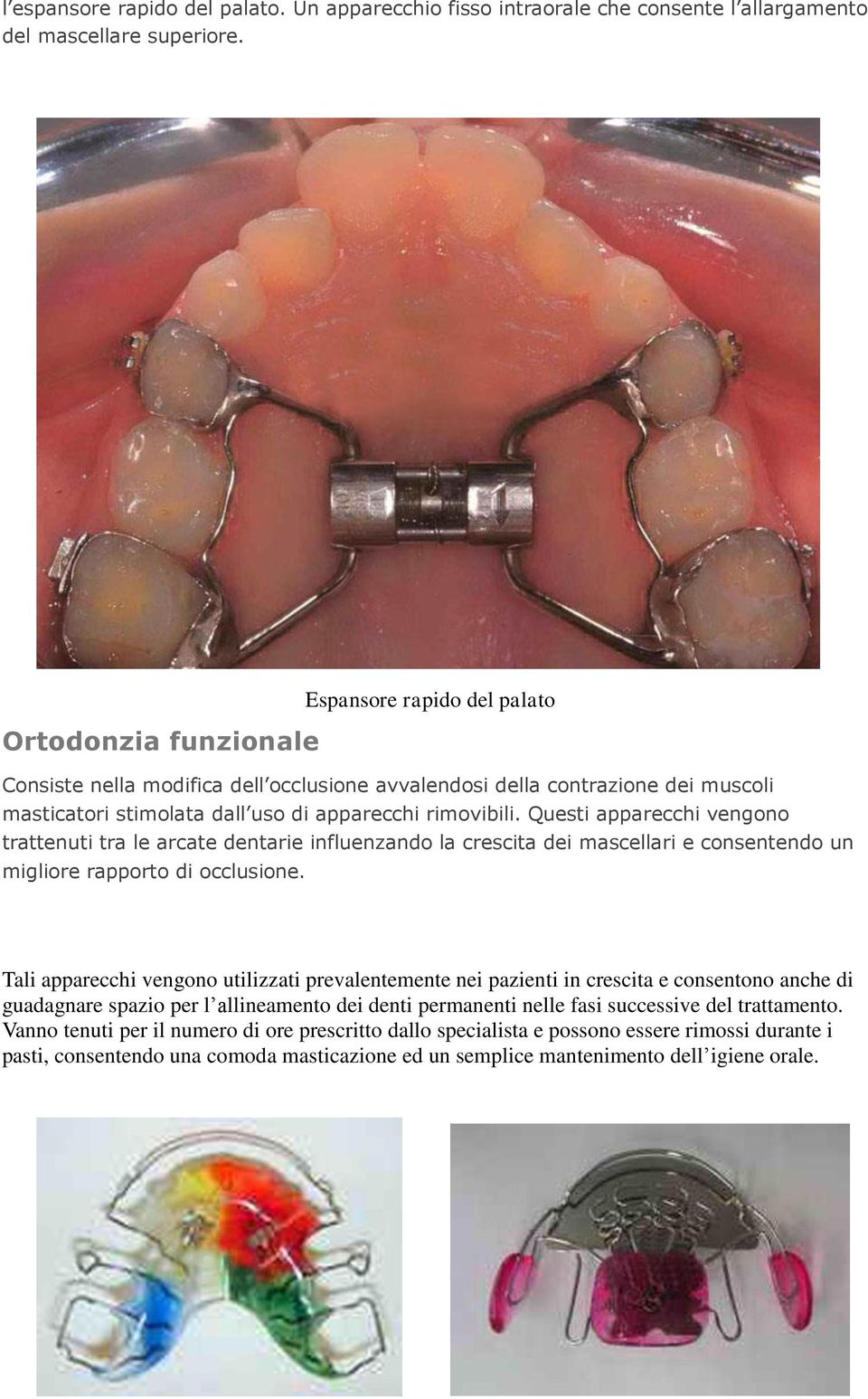 Questi apparecchi vengono trattenuti tra le arcate dentarie influenzando la crescita dei mascellari e consentendo un migliore rapporto di occlusione.