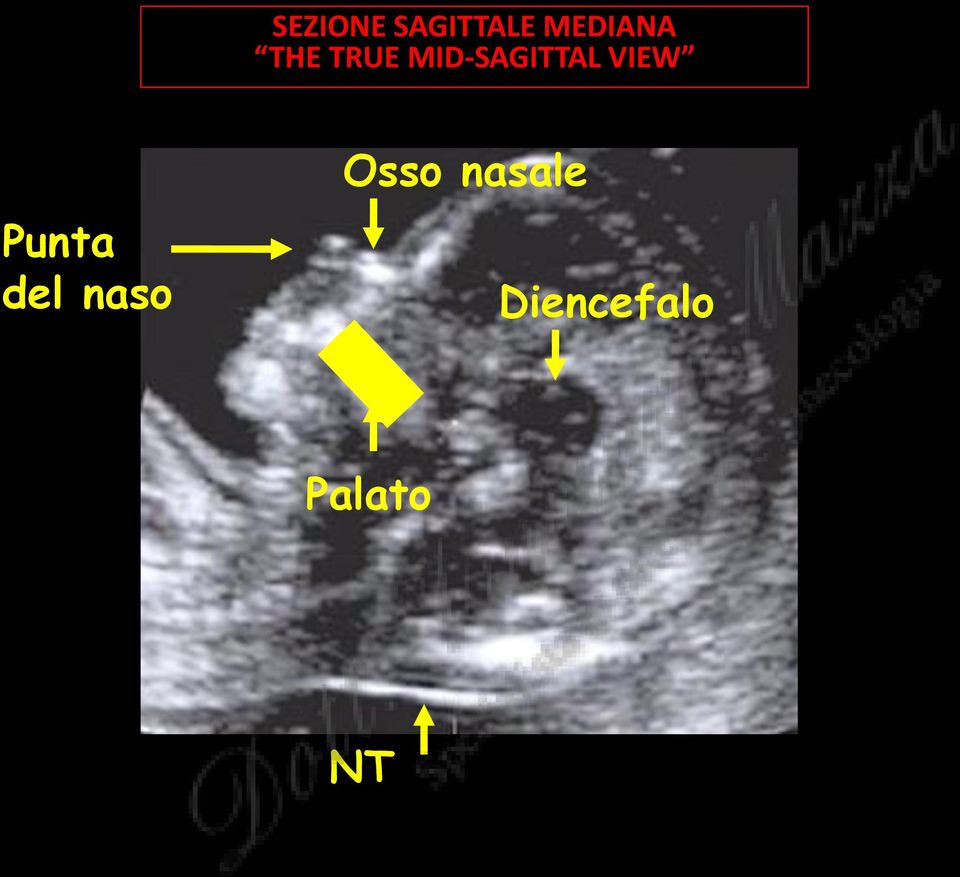 MID-SAGITTAL VIEW Punta