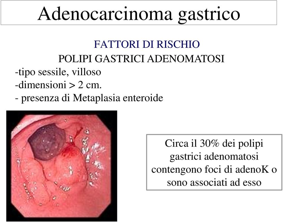 - presenza di Metaplasia enteroide Circa il 30% dei