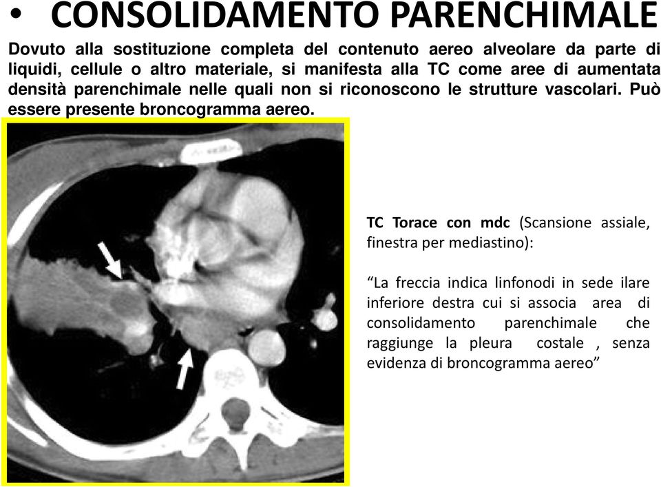 Può essere presente broncogramma aereo.