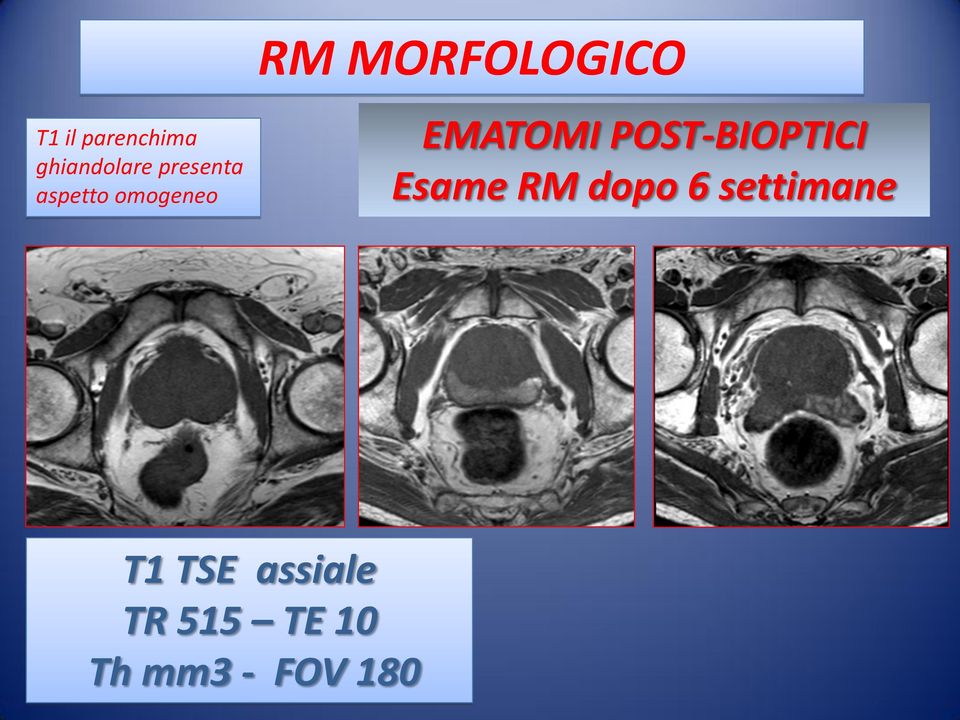 POST-BIOPTICI Esame RM dopo 6 settimane