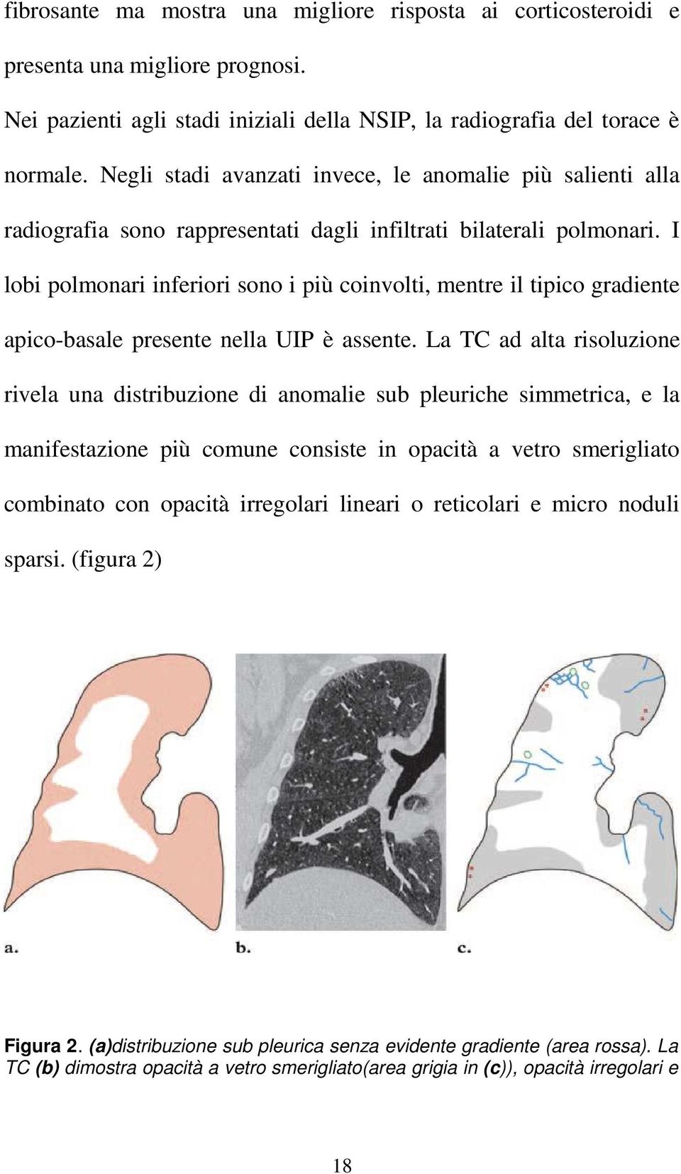 I lobi polmonari inferiori sono i più coinvolti, mentre il tipico gradiente apico-basale presente nella UIP è assente.