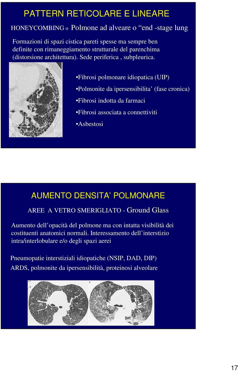 Fibrosi polmonare idiopatica (UIP) Polmonite da ipersensibilita (fase cronica) Fibrosi indotta da farmaci Fibrosi associata a connettiviti Asbestosi AUMENTO DENSITA POLMONARE AREE A