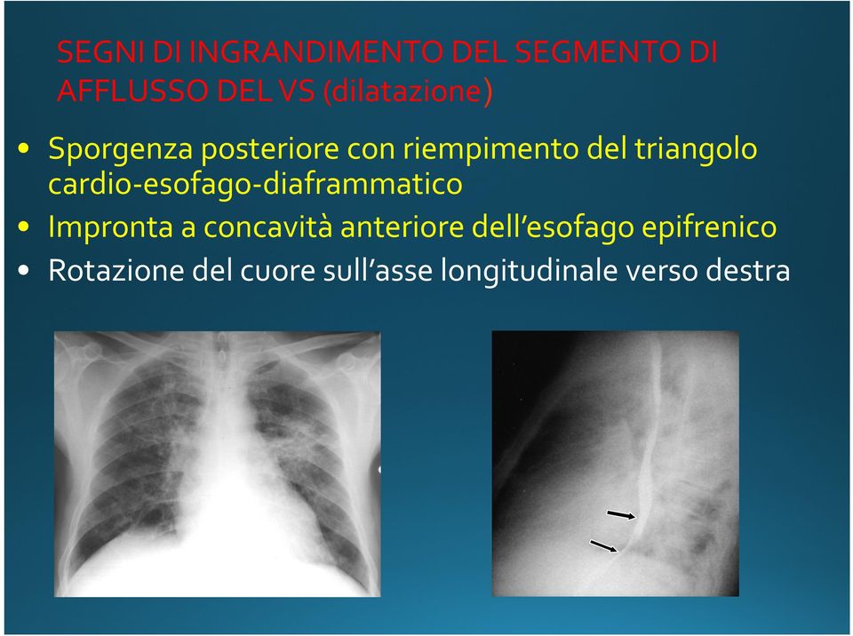 cardio- esofago- diaframmatico Impronta a concavità anteriore