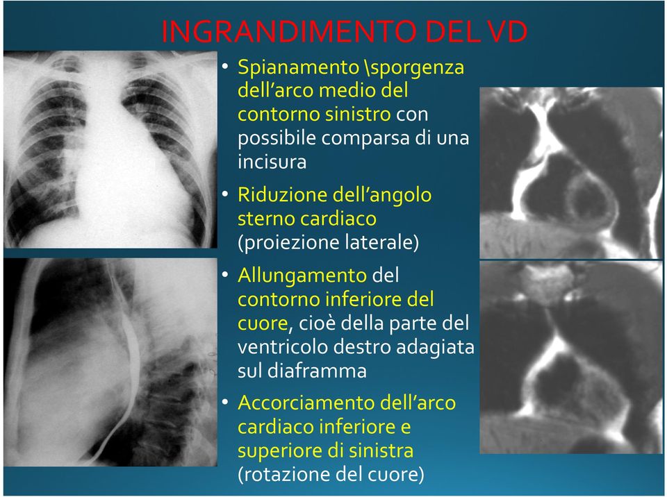 Allungamento del contorno inferiore del cuore, cioè della parte del ventricolo destro adagiata