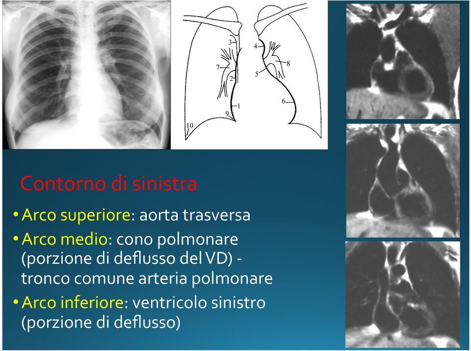 deflusso del VD) - tronco comune arteria polmonare