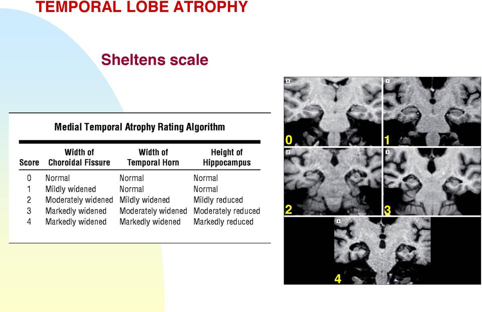 ATROPHY