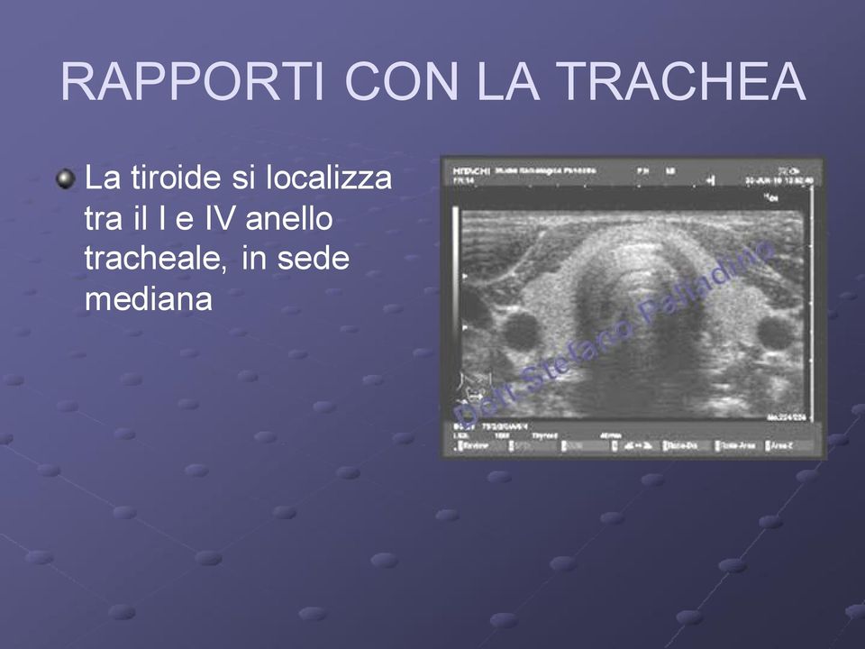 tra il I e IV anello