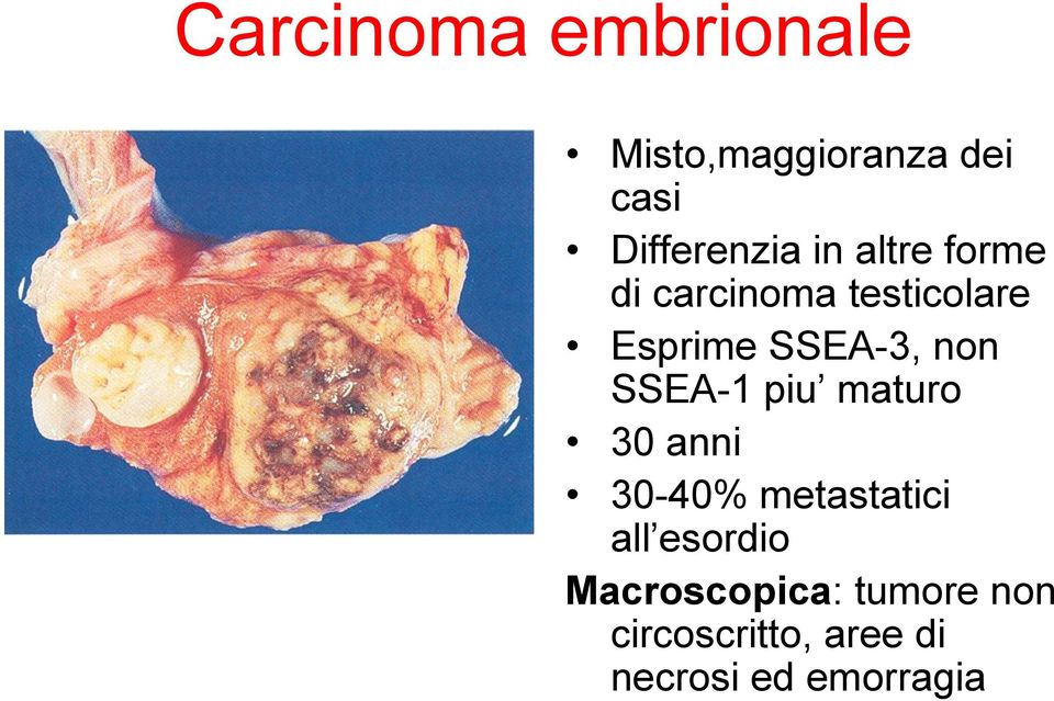 SSEA-1 piu maturo 30 anni 30-40% metastatici all esordio