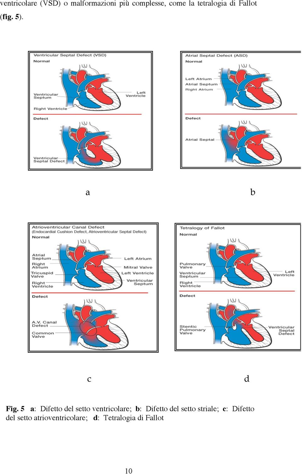 5 a: Difetto del setto ventricolare; b: Difetto del setto