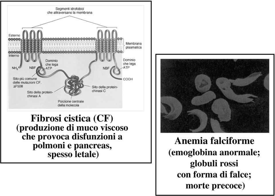 spesso letale) Anemia falciforme (emoglobina