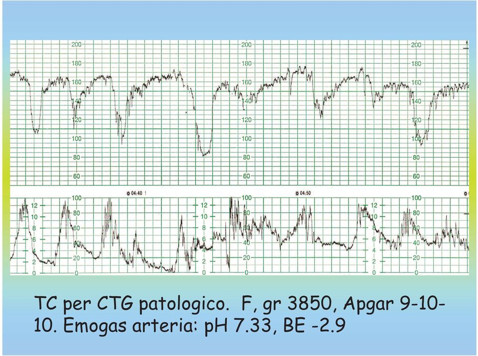 F, gr 3850, Apgar