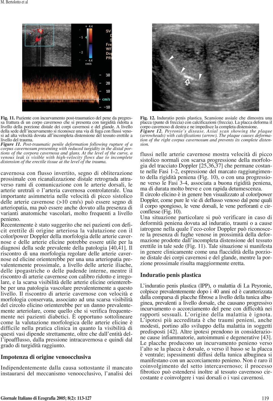 A livello della sede dell incurvamento si riconosce una via di fuga con flussi venosi ad alta velocità dovuta all incompleta distensione del tessuto erettile a livello del trauma. Figure 11.