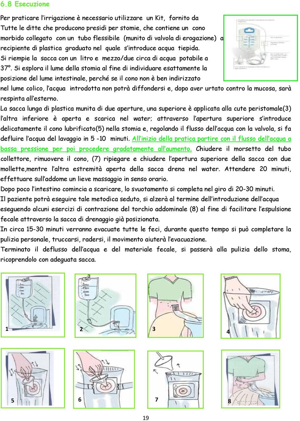 Si esplora il lume della stomia al fine di individuare esattamente la posizione del lume intestinale, perché se il cono non è ben indirizzato nel lume colico, l acqua introdotta non potrà diffondersi