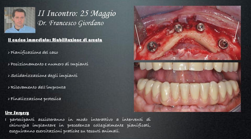 numero di Impianti Solidarizzazione degli impianti Rilevamento dell impronta Finalizzazione protesica Live