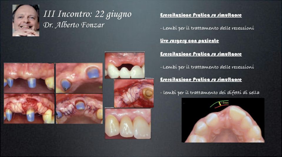 Live surgery con paziente Lembi bilaminari Esercitazione Pratica su simultaore -Lembi per il