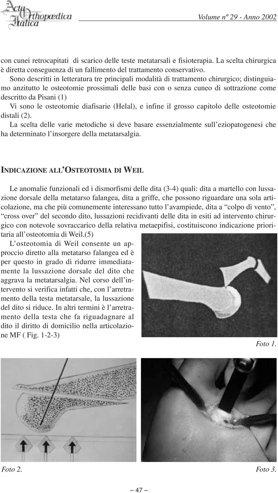 (1) Vi sono le osteotomie diafisarie (Helal), e infine il grosso capitolo delle osteotomie distali (2).
