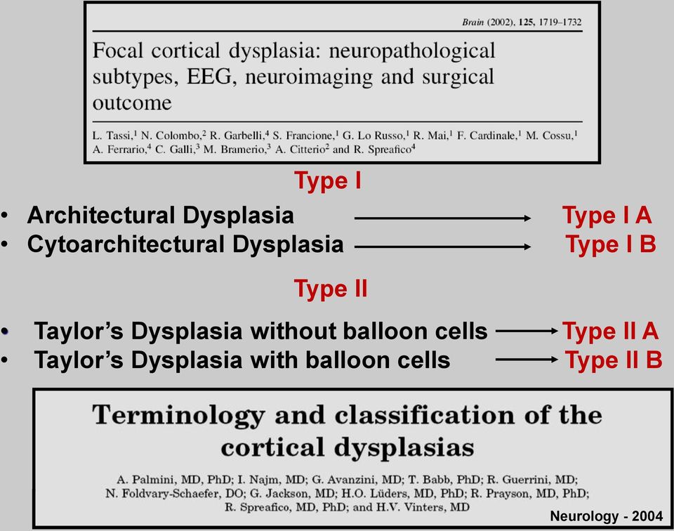 Taylor s Dysplasia without balloon cells Type II