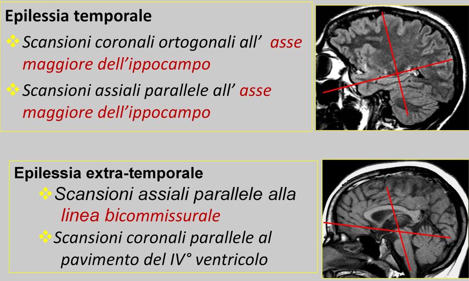 ippocampo Epilessia extra-temporale Scansioni assiali parallele alla