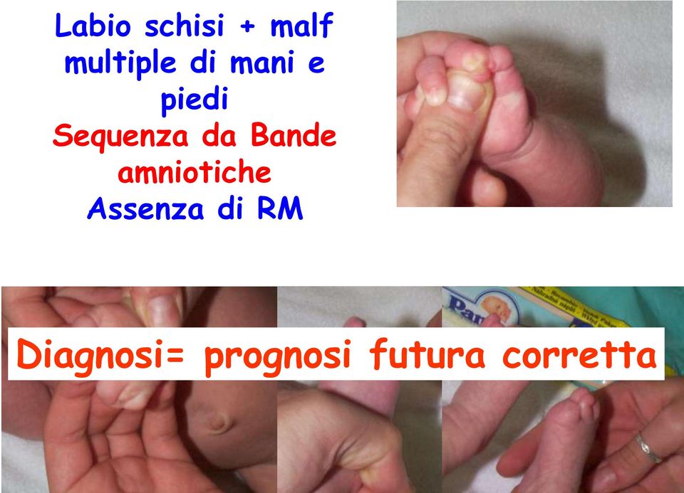 Bande amniotiche Assenza di RM