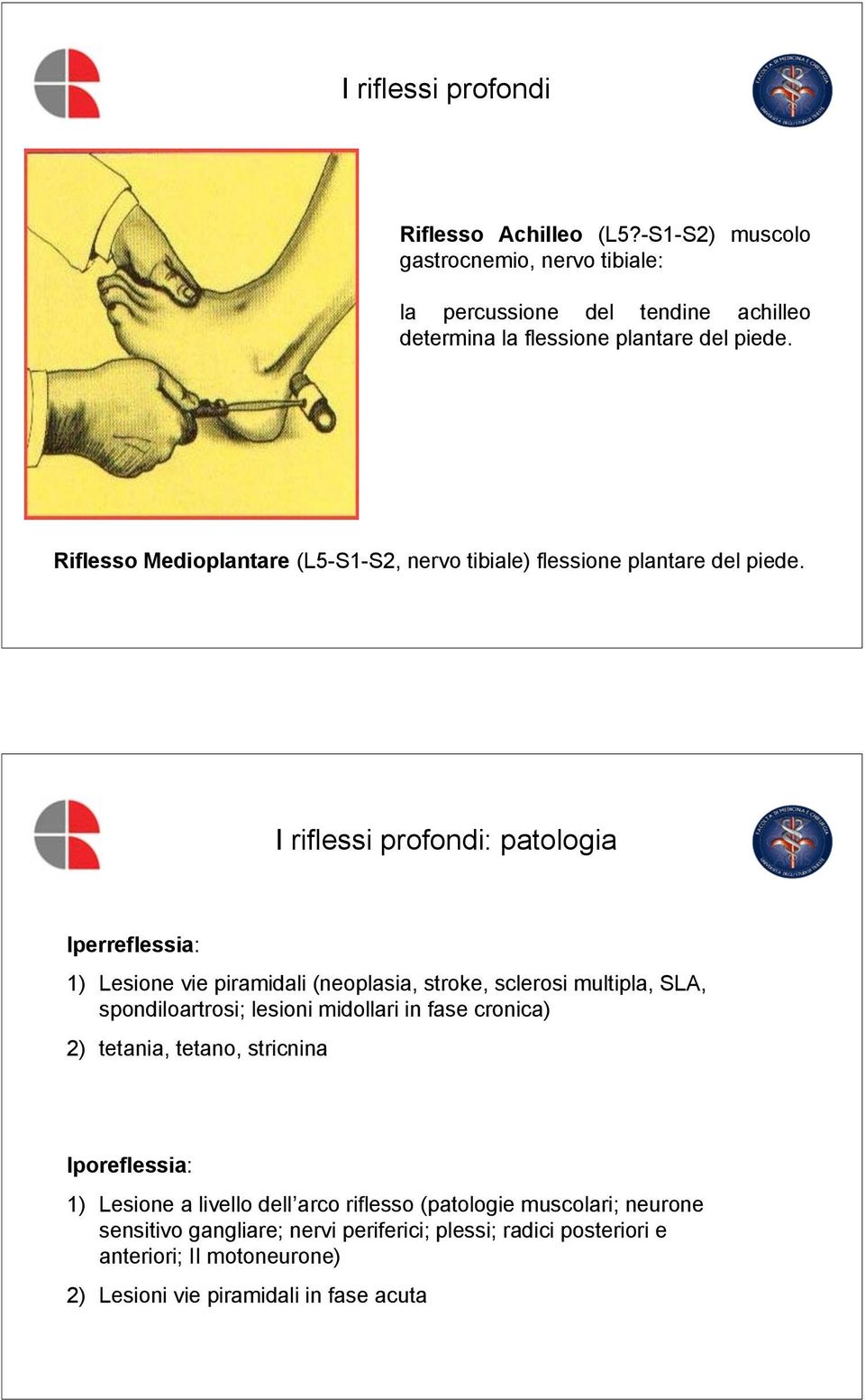 I riflessi profondi: patologia Iperreflessia: 1) Lesione vie piramidali (neoplasia, stroke, sclerosi multipla, SLA, spondiloartrosi; lesioni midollari in fase