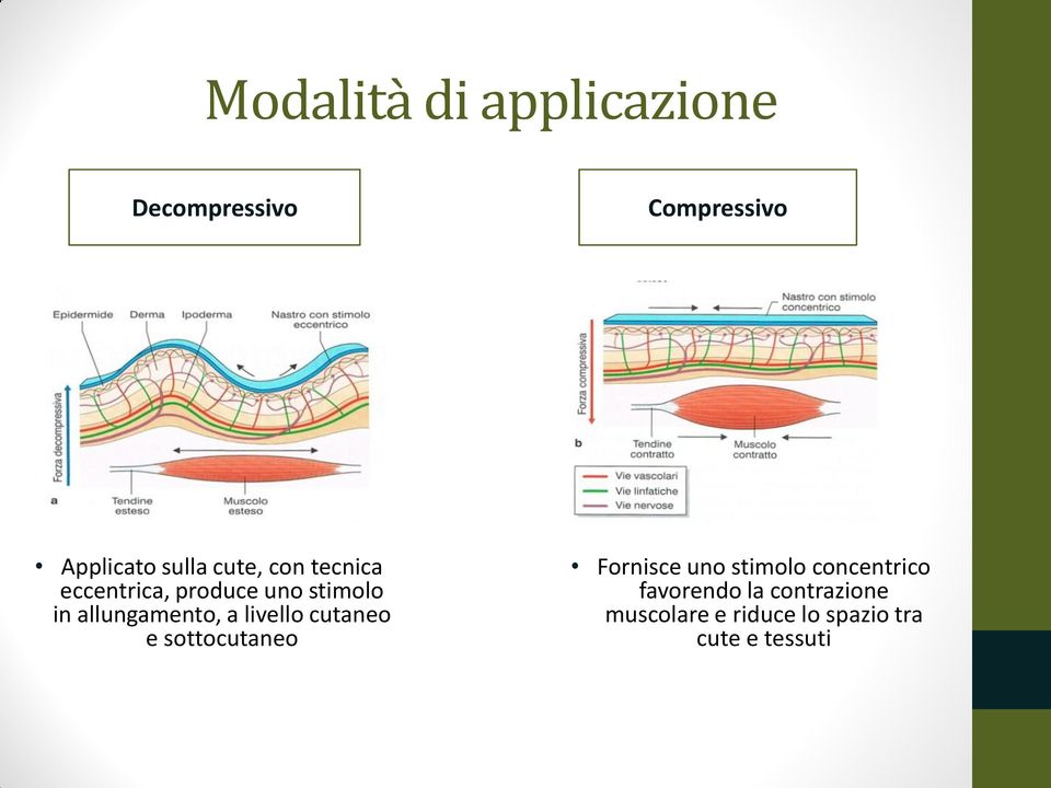 a livello cutaneo e sottocutaneo Fornisce uno stimolo concentrico