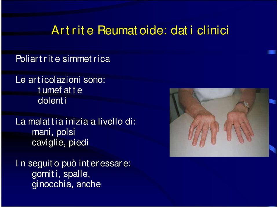 La malattia inizia a livello di: mani, polsi caviglie,