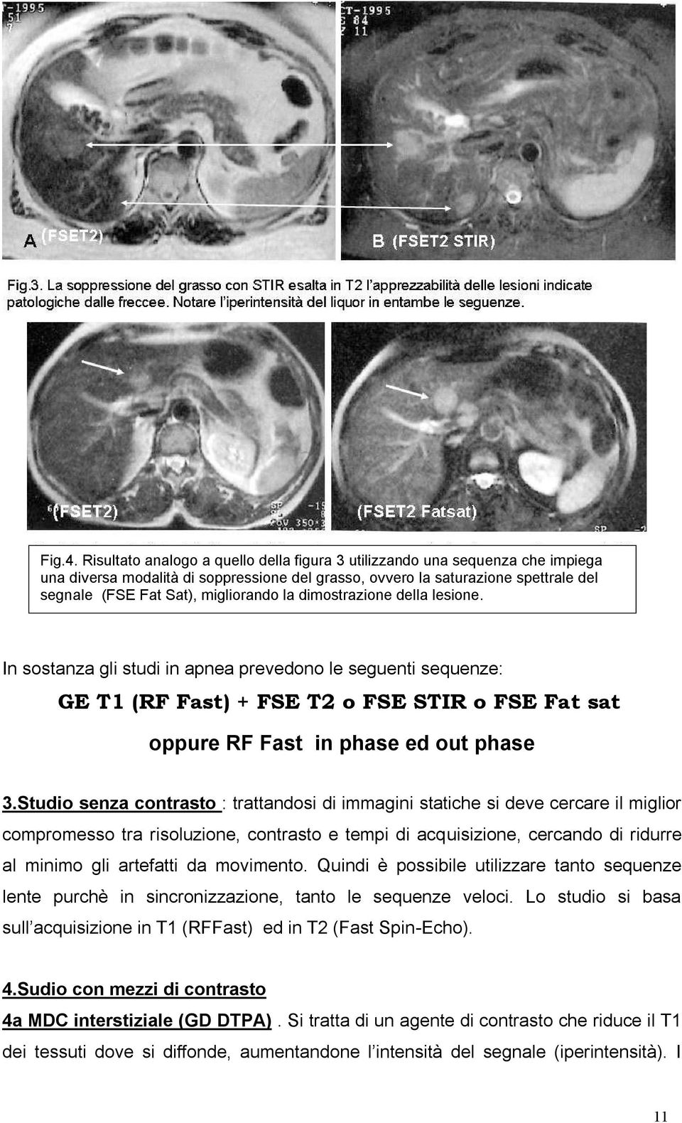 la dimostrazione della lesione. In sostanza gli studi in apnea prevedono le seguenti sequenze: GE T1 (RF Fast) + FSE T2 o FSE STIR o FSE Fat sat oppure RF Fast in phase ed out phase 3.