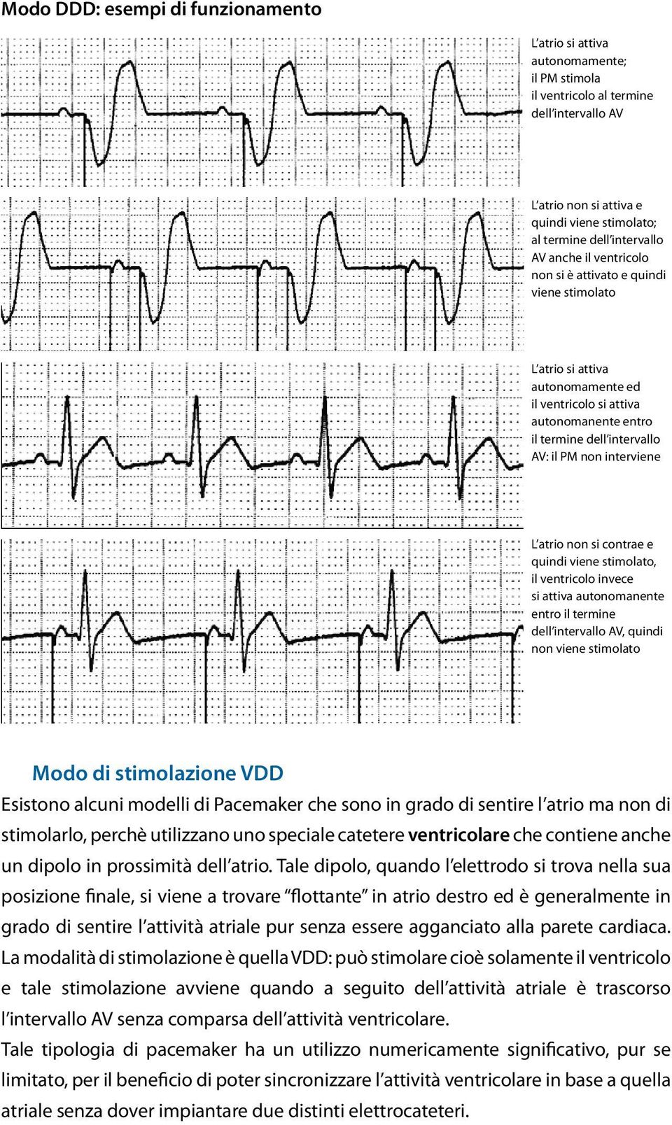 atrio non si contrae e quindi viene stimolato, il ventricolo invece si attiva autonomanente entro il termine dell intervallo AV, quindi non viene stimolato Modo di stimolazione VDD Esistono alcuni