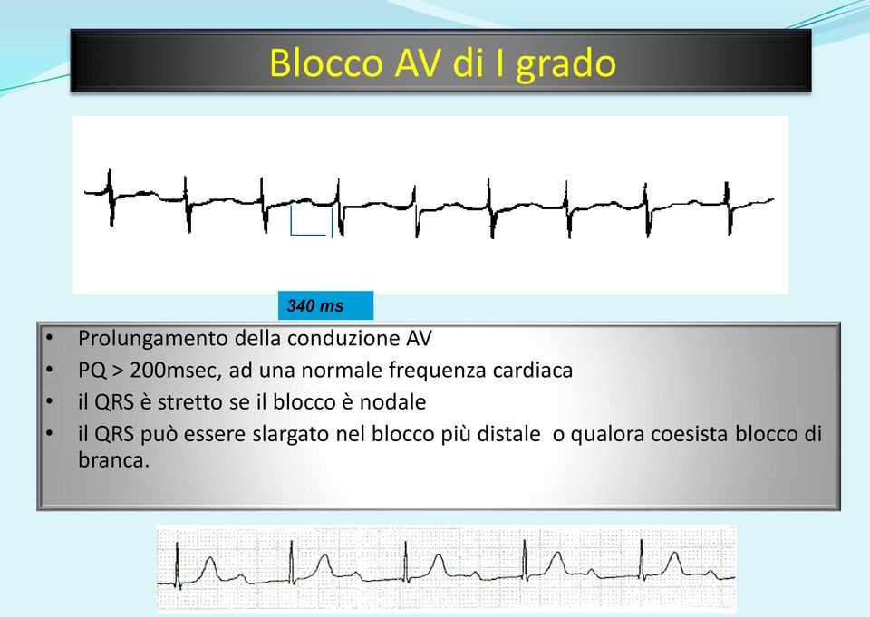 stretto se il blocco è nodale il QRS può essere