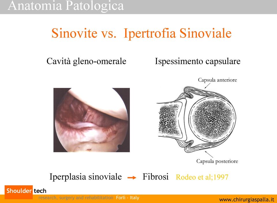 gleno-omerale Iperplasia sinoviale
