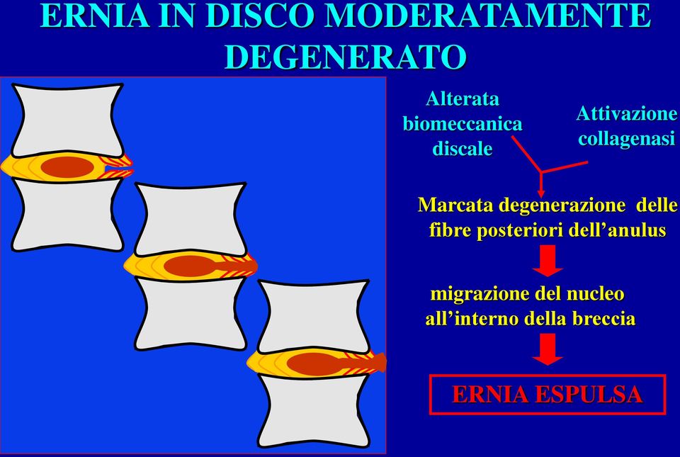 degenerazione delle fibre posteriori dell anulus