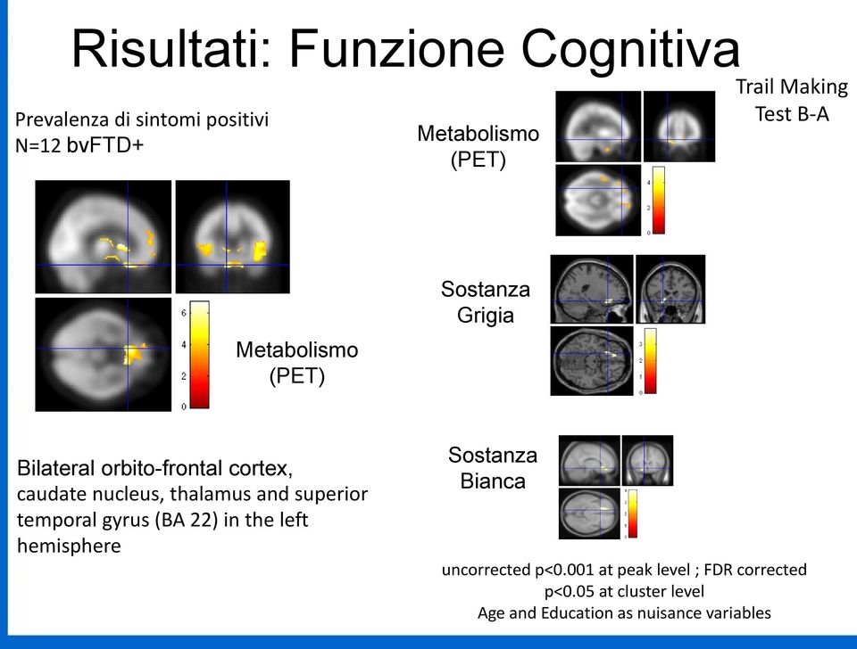 nucleus, thalamus and superior temporal gyrus (BA 22) in the left hemisphere Sostanza Bianca