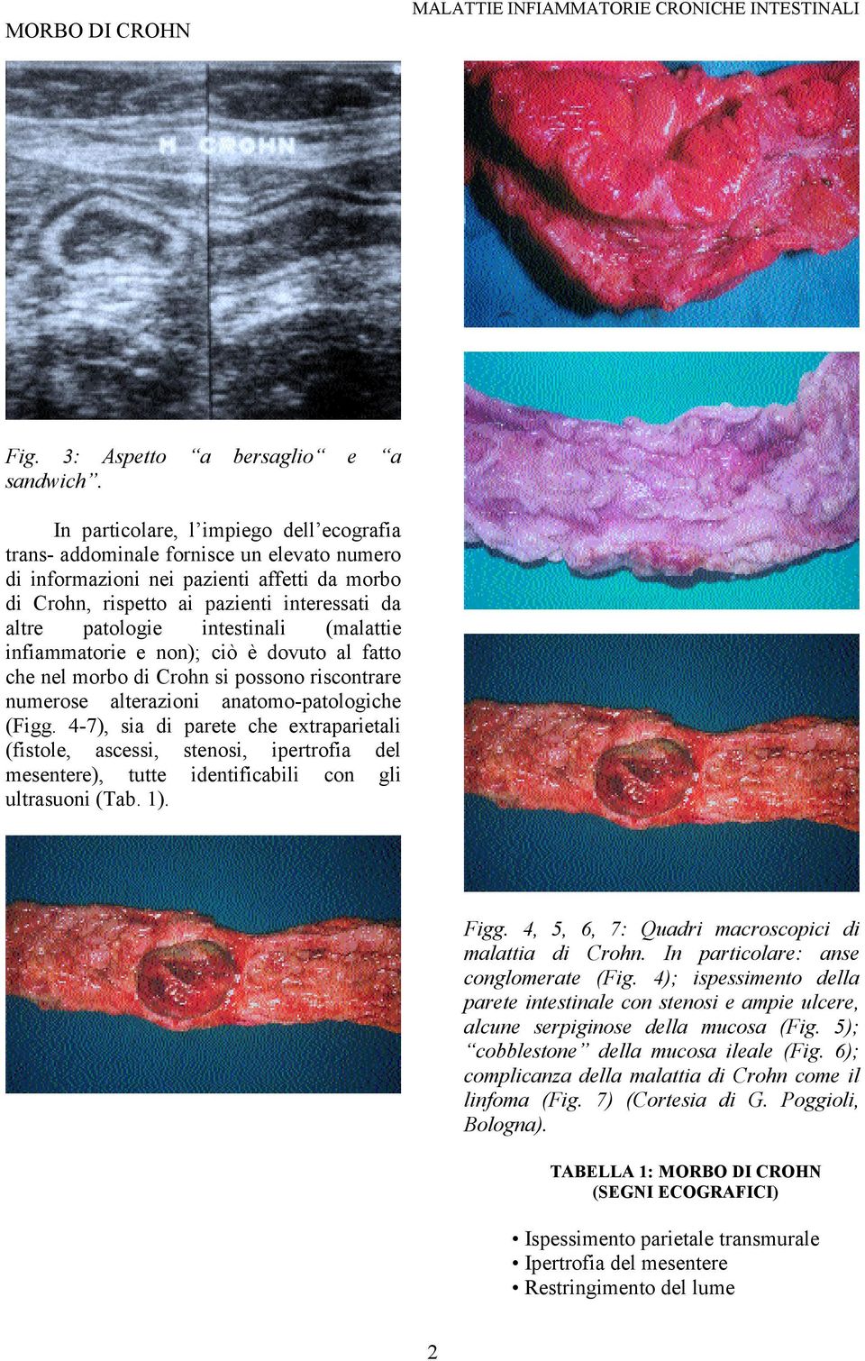 intestinali (malattie infiammatorie e non); ciò è dovuto al fatto che nel morbo di Crohn si possono riscontrare numerose alterazioni anatomo-patologiche (Figg.