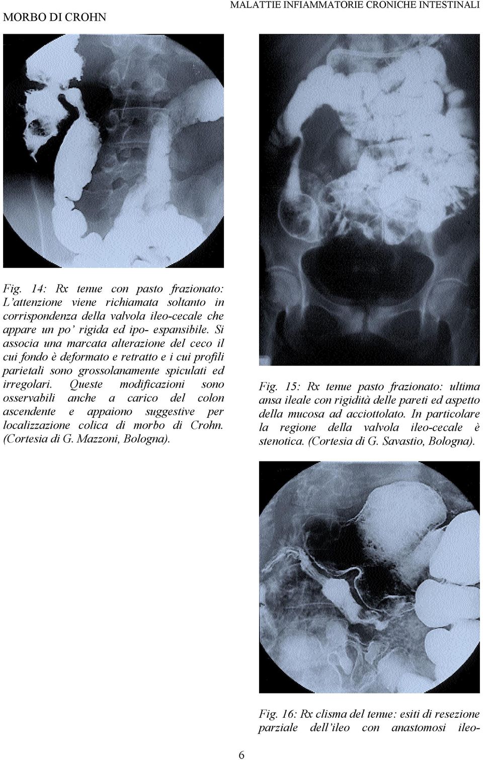 Queste modificazioni sono osservabili anche a carico del colon ascendente e appaiono suggestive per localizzazione colica di morbo di Crohn. (Cortesia di G. Mazzoni, Bologna). Fig.