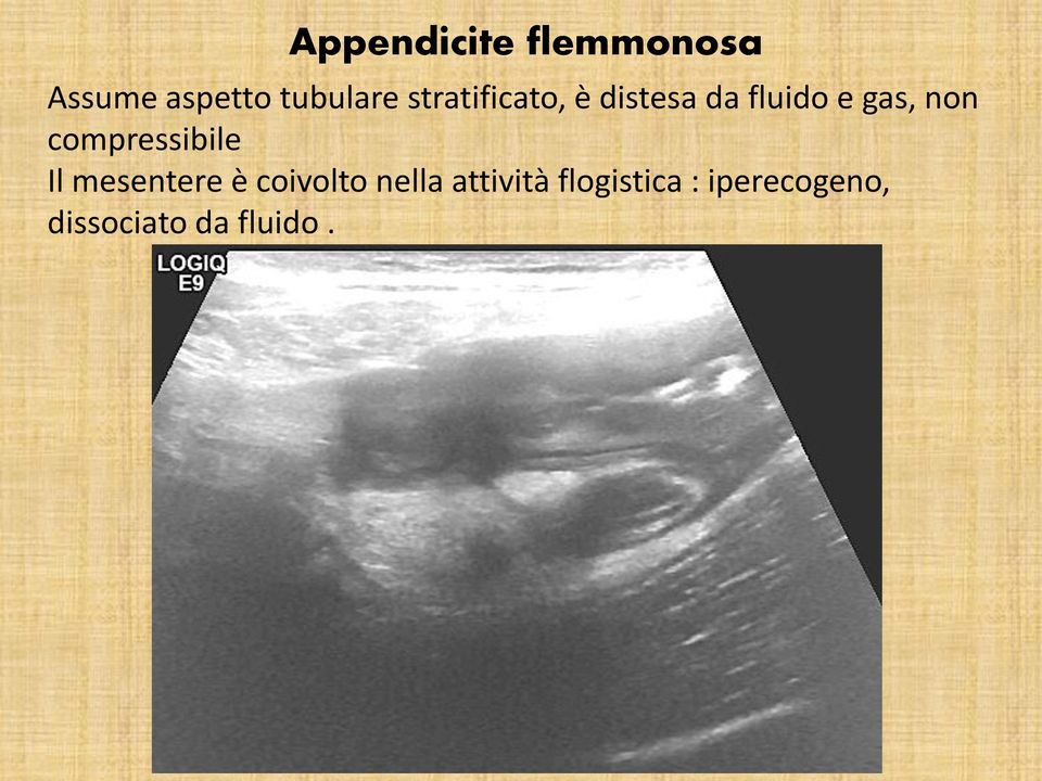 compressibile Il mesentere è coivolto nella