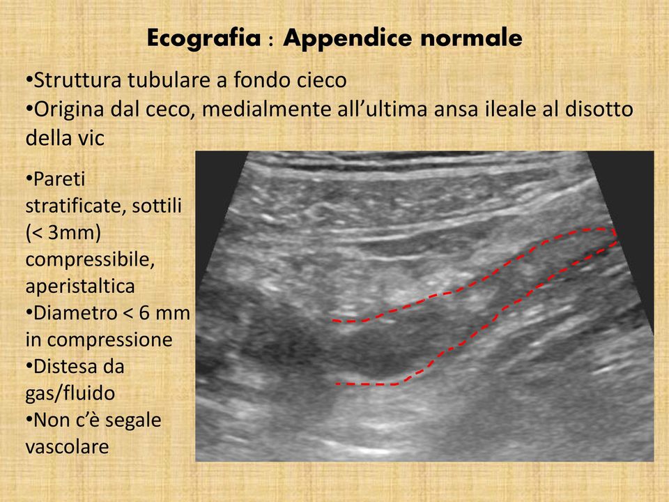 Pareti stratificate, sottili (< 3mm) compressibile, aperistaltica