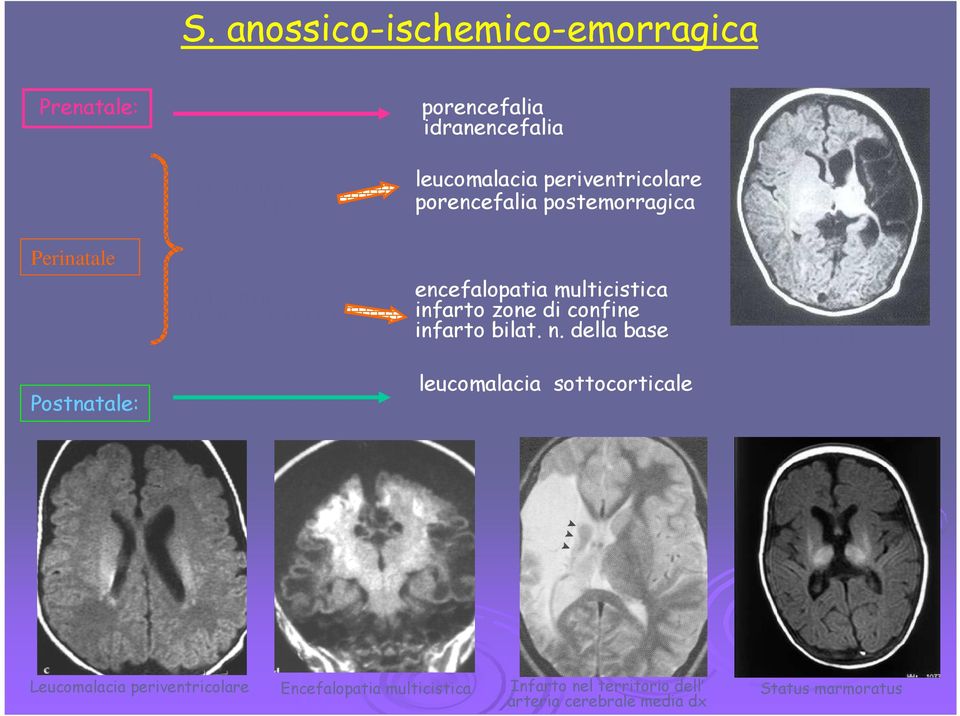 ) Postnatale: Leucomalacia periventricolare encefalopatia multicistica infarto zone di confine infarto bilat. n.