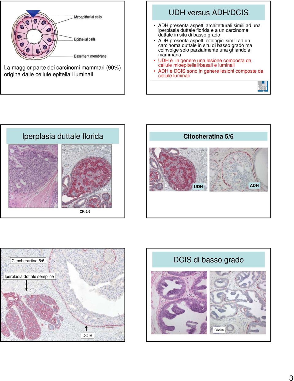 coinvolge solo parzialmente una ghiandola mammaria UDH è in genere una lesione composta da cellule mioepiteliali/basali e luminali ADH e DCIS sono in genere