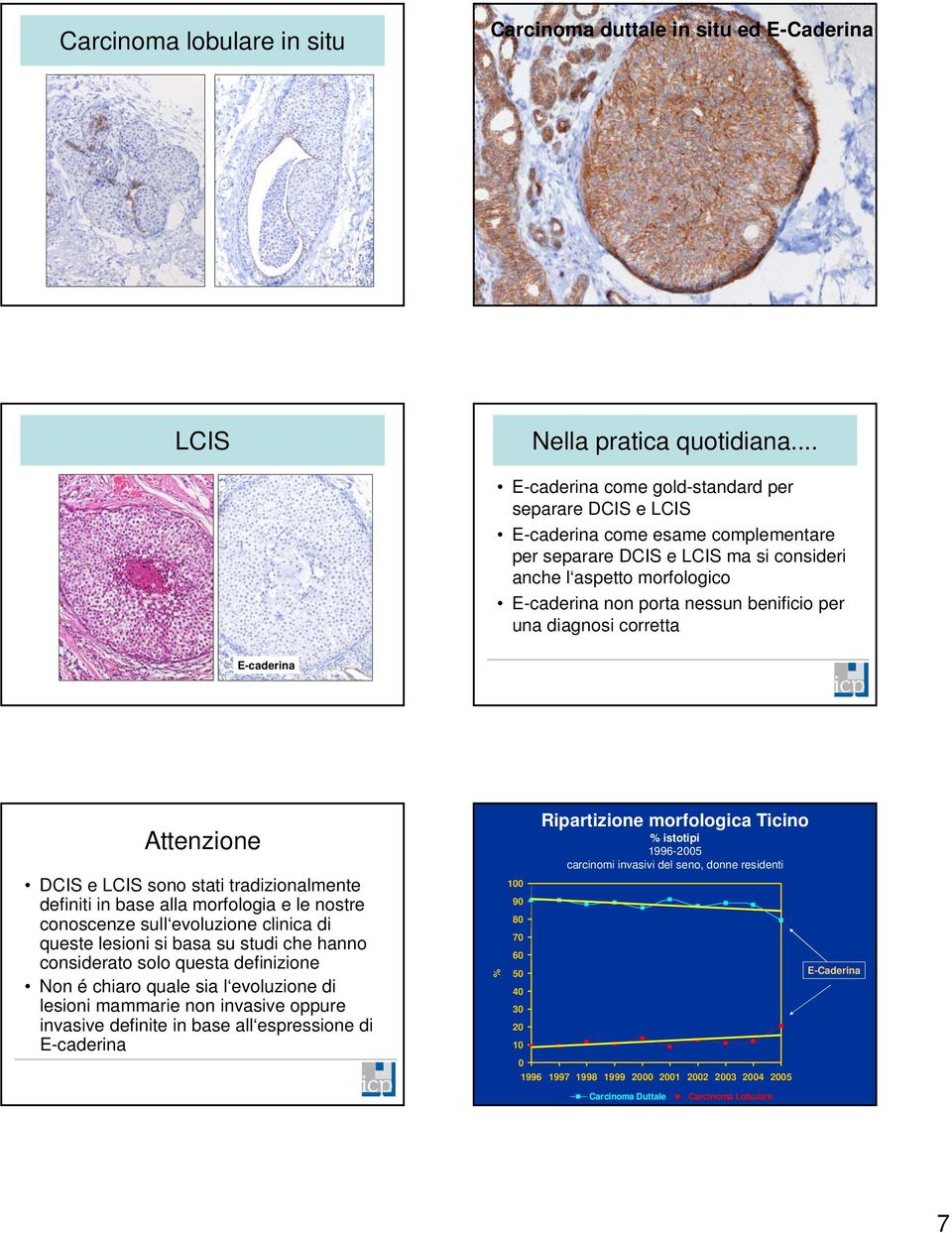 benificio per una diagnosi corretta E-caderina Attenzione DCIS e LCIS sono stati tradizionalmente definiti in base alla morfologia e le nostre conoscenze sull evoluzione clinica di queste lesioni si