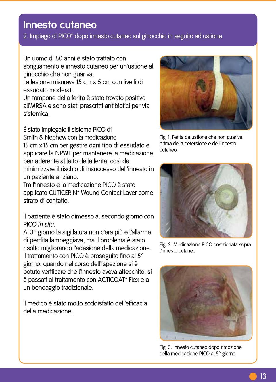 La lesione misurava 15 cm x 5 cm con livelli di essudato moderati. Un tampone della ferita è stato trovato positivo all MRSA e sono stati prescritti antibiotici per via sistemica.