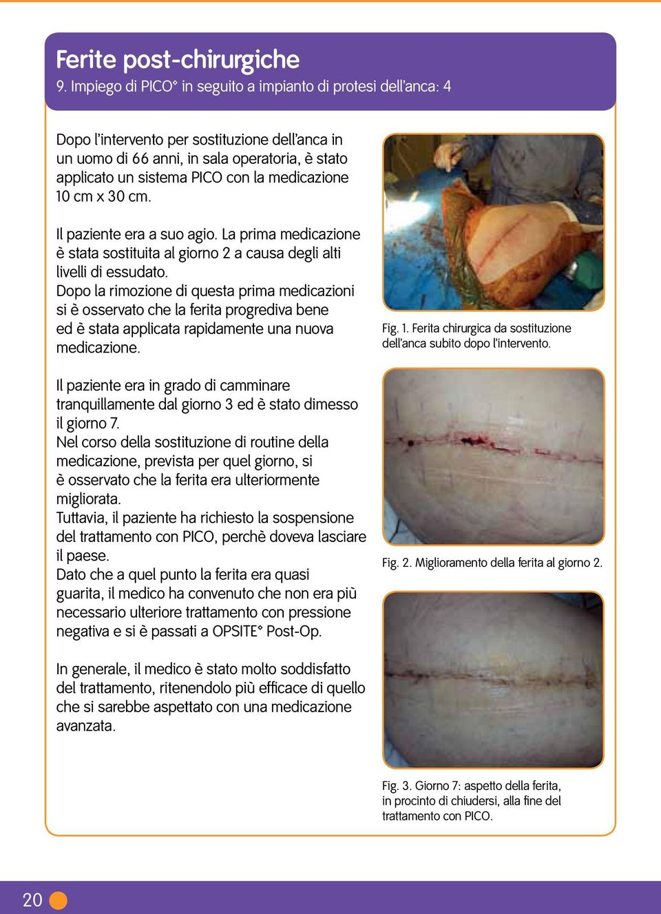 x 30 cm. Il paziente era a suo agio. La prima medicazione è stata sostituita al giorno 2 a causa degli alti livelli di essudato.