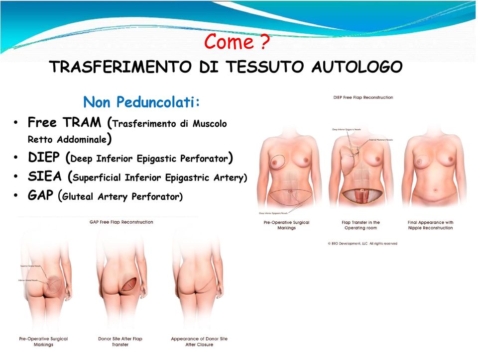 DIEP (Deep Inferior Epigastic Perforator) SIEA