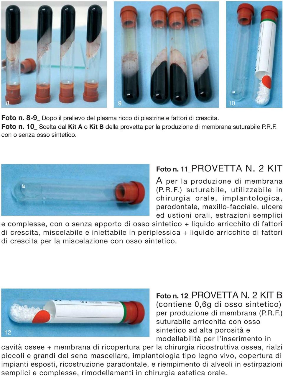 semplici e complesse, con o senza apporto di osso sintetico + liquido arricchito di fattori di crescita, miscelabile e iniettabile in periplessica + liquido arricchito di fattori di crescita per la